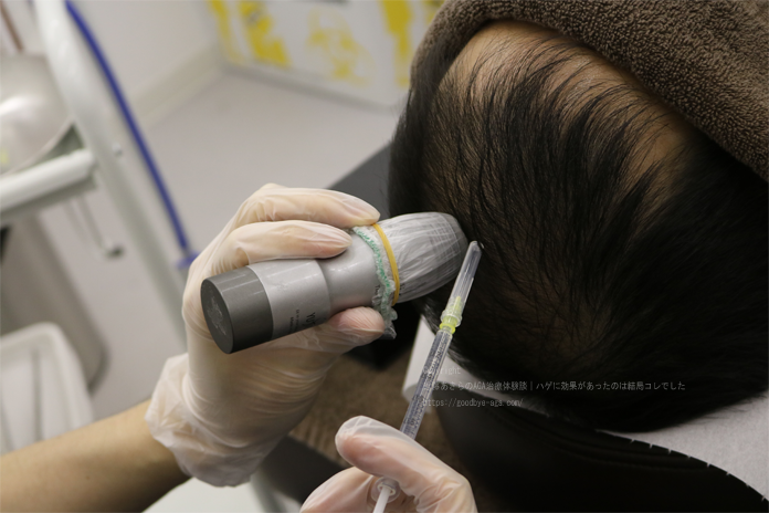 育毛メソセラピーの効果とは？主なクリニックの費用目安と有効成分の